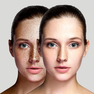 Treat Skin Pigmentation with Home Remedies